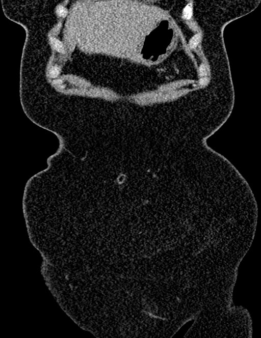 Bilateral staghorn calculi (Radiopaedia 59475-66842 Coronal non-contrast 35).jpg