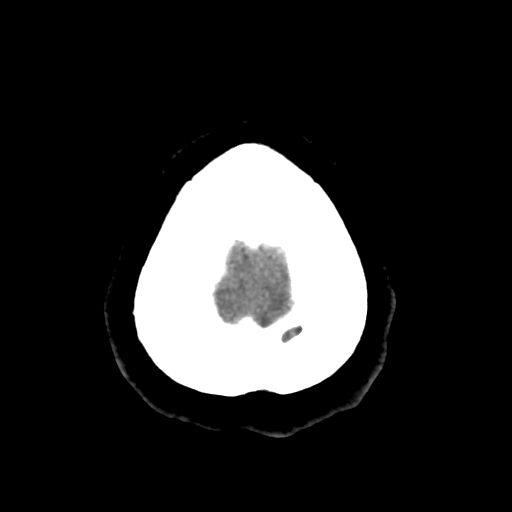 Bilateral subacute subdural hematoma (Radiopaedia 69240-79018 Axial non-contrast 48).jpg