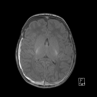 File:Bilateral subdural hemorrhage and parietal skull fracture (Radiopaedia 26058-26190 Axial T1 30).png