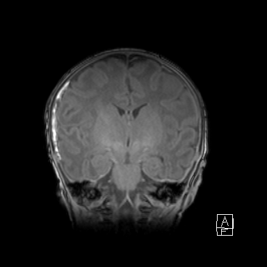 Bilateral subdural hemorrhage and parietal skull fracture (Radiopaedia 26058-26190 Coronal T1 27).png