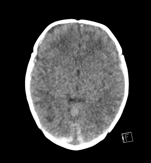 File:Bilateral subdural hemorrhage and parietal skull fracture (Radiopaedia 26058-26192 Axial non-contrast 14).png