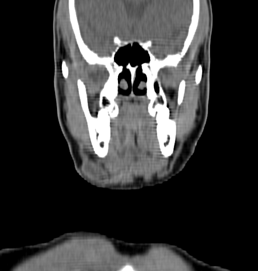 Bilateral submandibular sialolithiasis with sialadenitis (Radiopaedia 70721-80881 Coronal non-contrast 2).jpg