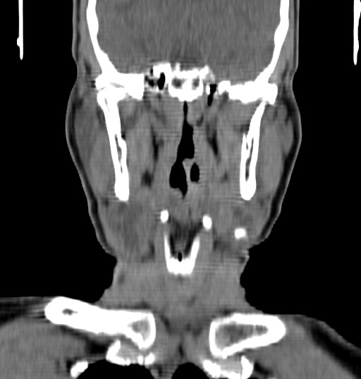 Bilateral submandibular sialolithiasis with sialadenitis (Radiopaedia 70721-80881 Coronal non-contrast 49).jpg