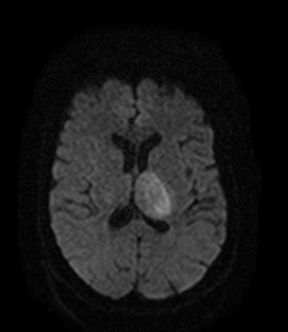 File:Bilateral thalamic glioma (Radiopaedia 65852-75009 Axial DWI 12).jpg