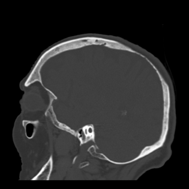 Biparietal osteodystrophy (Radiopaedia 46109-50463 Sagittal bone window 32).jpg