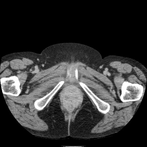 Bladder tumor detected on trauma CT (Radiopaedia 51809-57609 C 148).jpg