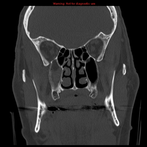 File:Blowout fracture with inferior rectus entrapment (Radiopaedia 12418-12673 Coronal bone window 13).jpg