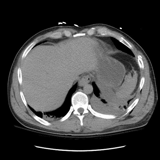 Blunt abdominal trauma with solid organ and musculoskelatal injury with active extravasation (Radiopaedia 68364-77895 Axial C+ delayed 22).jpg