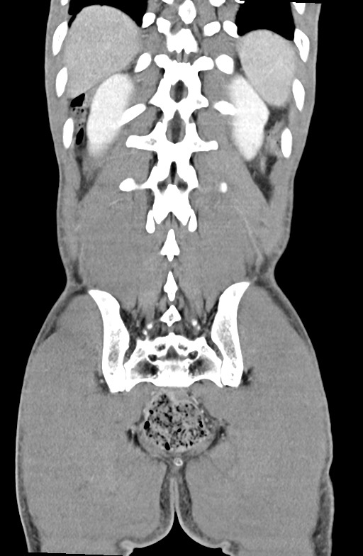 Blunt injury to the small bowel (Radiopaedia 74953-85987 B 79).jpg