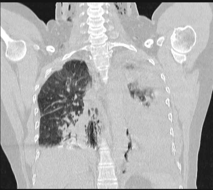Boerhaave syndrome (Radiopaedia 45644-49799 Coronal lung window 46).jpg