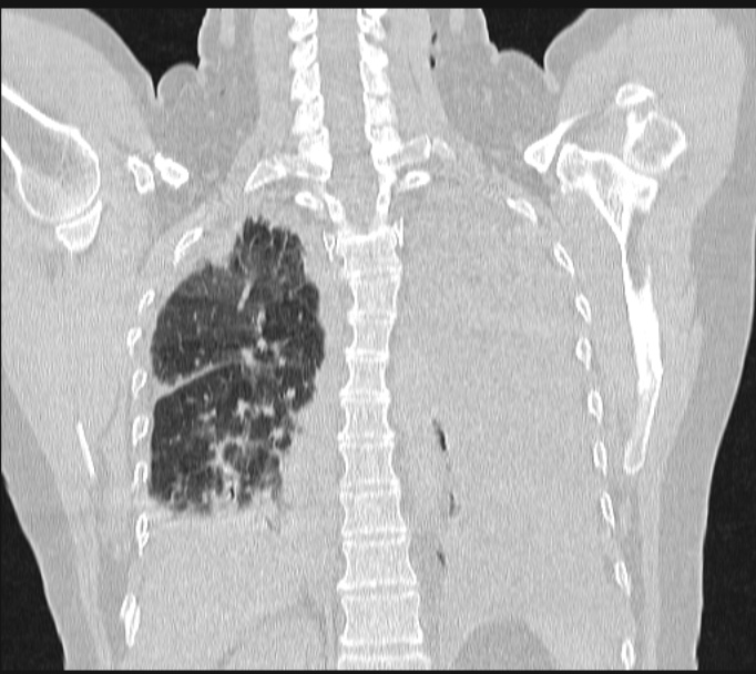 Boerhaave syndrome (Radiopaedia 45644-49799 Coronal lung window 50).jpg