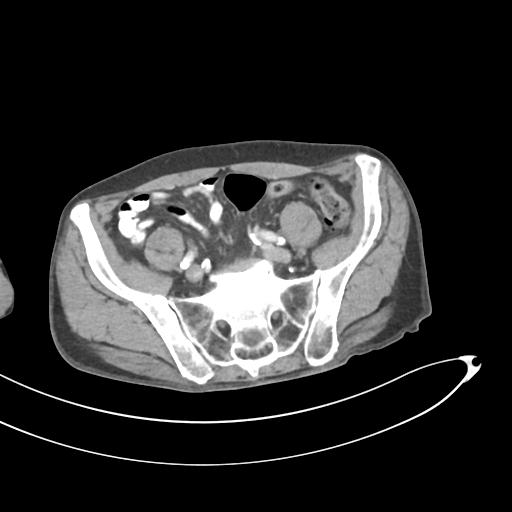 Bone metastasis from squamous cell carcinoma (Radiopaedia 30133-30730 B 56).jpg