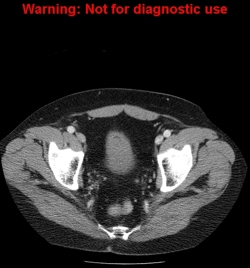 File:Bosniak renal cyst - type IV (Radiopaedia 23402-23466 D 72).jpg