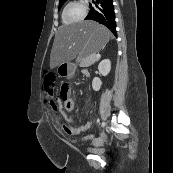 Bowel and splenic infarcts in acute lymphocytic leukemia (Radiopaedia 61055-68915 C 29).jpg