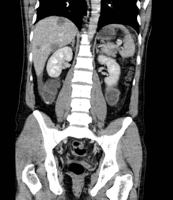 Bowel obstruction from colon carcinoma (Radiopaedia 22995-23028 C 49).jpg
