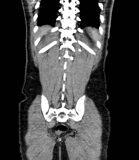 Bowel obstruction from colon carcinoma (Radiopaedia 22995-23028 C 65).jpg