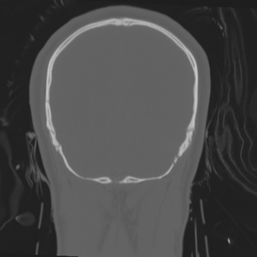 File:Brain contusions, internal carotid artery dissection and base of skull fracture (Radiopaedia 34089-35339 Coronal bone window 55).png