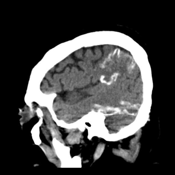 Brain cortical laminar necrosis (Radiopaedia 25822-25971 non-contrast 40).jpg