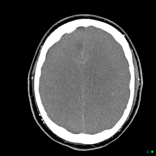 Brain death on MRI and CT angiography (Radiopaedia 42560-45841 B 19).jpg