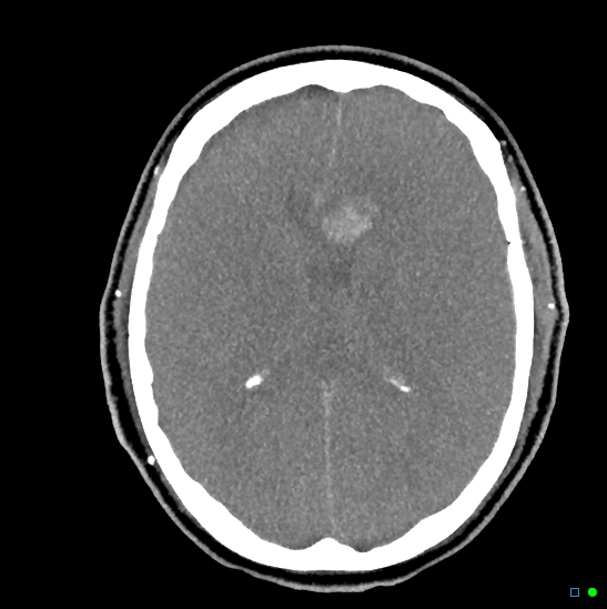 Brain death on MRI and CT angiography (Radiopaedia 42560-45841 B 24).jpg