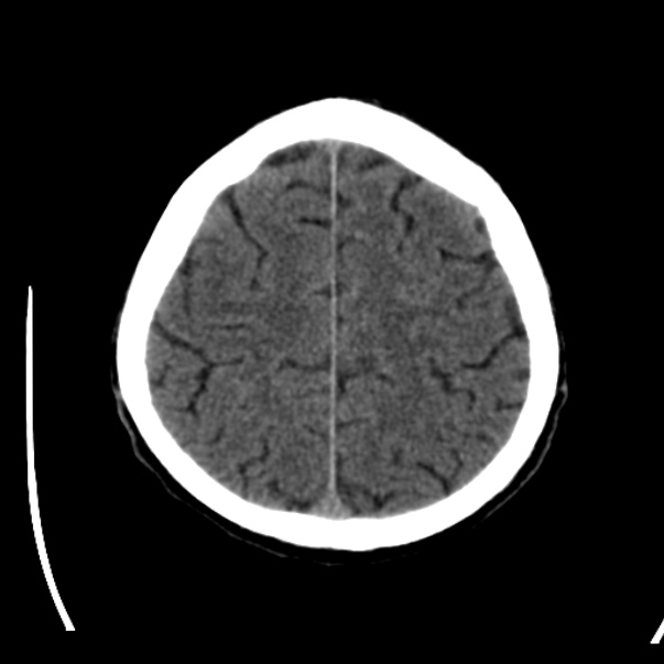 Brain metastases from lung cancer (Radiopaedia 24480-24781 Axial non-contrast 40).jpg