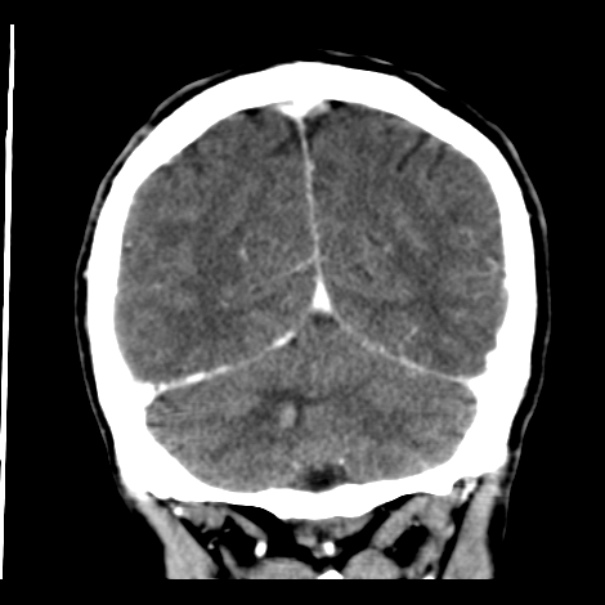 Brain metastases from lung cancer (Radiopaedia 24480-24781 Coronal C+ delayed 49).jpg