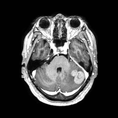 Brain metastases from lung cancer (Radiopaedia 83839-99028 Axial T1 C+ 15).jpg
