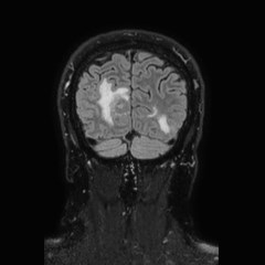 File:Brain metastases from lung cancer (Radiopaedia 83839-99028 Coronal FLAIR 72).jpg
