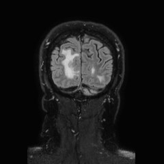 File:Brain metastases from lung cancer (Radiopaedia 83839-99028 Coronal FLAIR 75).jpg