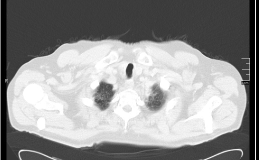 File:Brain metastases from squamocellular lung cancer (Radiopaedia 56515-63219 Axial lung window 11).jpg