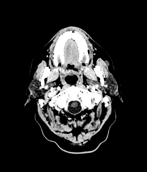 Brain metastasis (large cystic mass) (Radiopaedia 47497-52106 Axial C+ 8).png