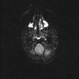 Brainstem glioma (Radiopaedia 67531-76922 Axial DWI 4).jpg