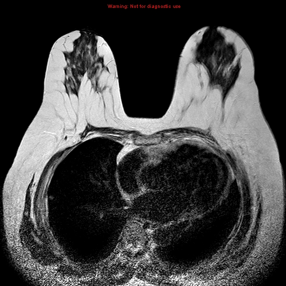 File:Breast carcinoma (multicentric multifocal in mammary Paget disease) (Radiopaedia 50966-56512 Axial T2 6).jpg
