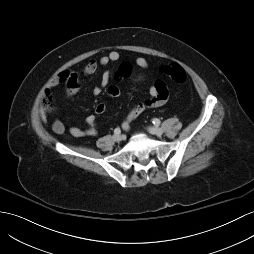 Breast carcinoma with pathological hip fracture (Radiopaedia 60314-67974 B 50).jpg