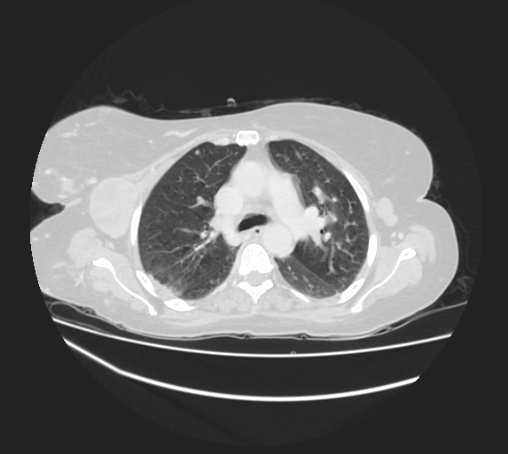 Breast metastases from facial malignant melanoma (Radiopaedia 60316-67975 Axial lung window 36).jpg