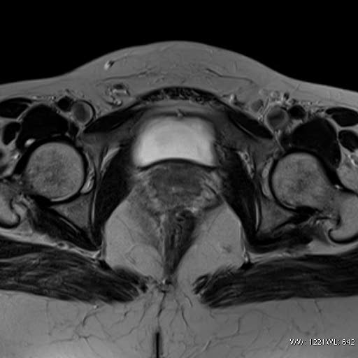File:Broad ligament fibroid (Radiopaedia 49135-54241 Axial T2 23).jpg