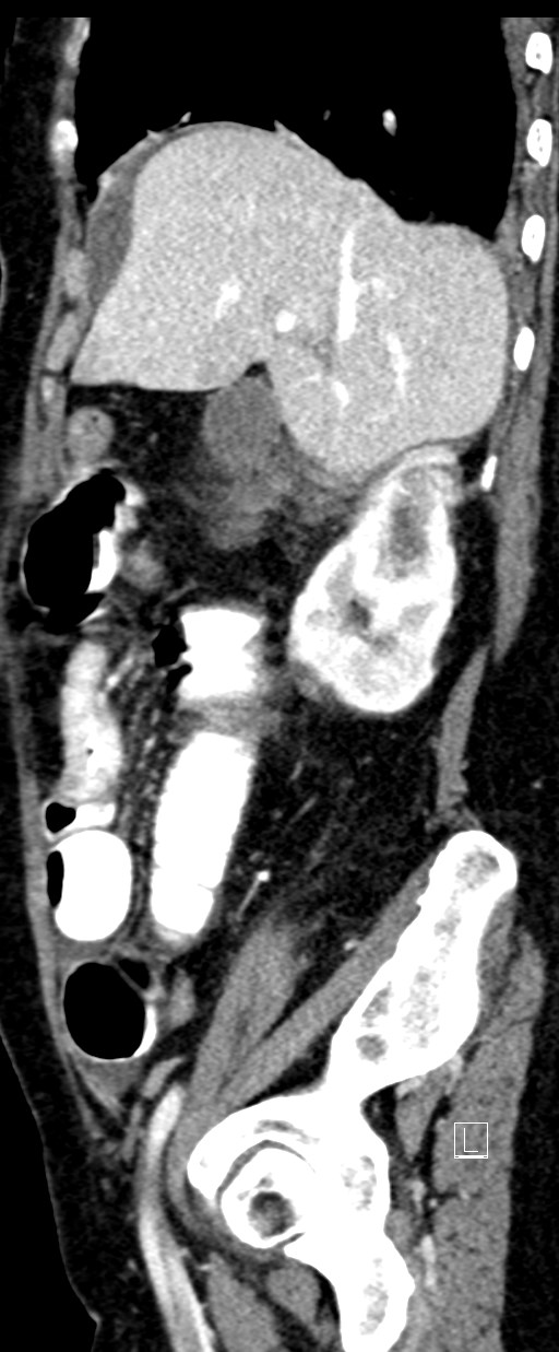Broad ligament hernia (Radiopaedia 84802-100276 C 60).jpg