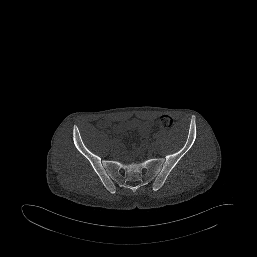 Brodie abscess- femoral neck (Radiopaedia 53862-59966 Axial bone window 61).jpg