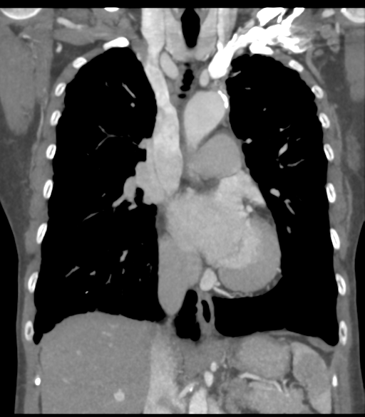 Bronchial artery aneurysms (Radiopaedia 42282-45385 Coronal C+ delayed 31).png