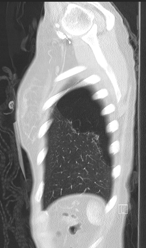 Bronchial atresia (Radiopaedia 73677-84470 Sagittal lung window 50).jpg