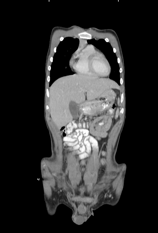 Bronchial carcinoid tumor (Radiopaedia 57187-64090 B 8).jpg