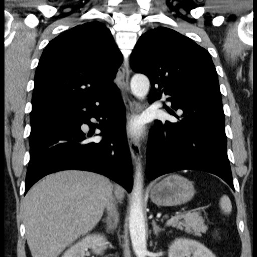 Bronchial carcinoid tumor (Radiopaedia 67377-76764 C 41).jpg