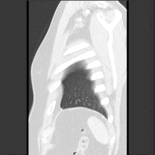 Bronchial carcinoid tumor (Radiopaedia 67377-76764 Sagittal lung window 62).jpg