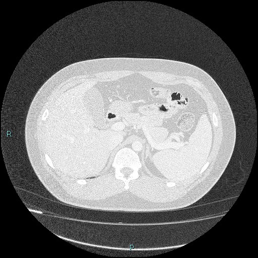 Bronchial carcinoid tumor (Radiopaedia 78272-90875 Axial lung window 57).jpg