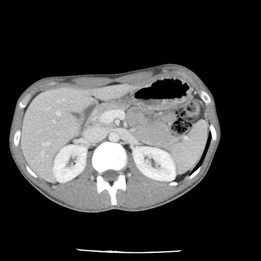 Bronchial carcinoid tumor causing right lower lobe collapse (Radiopaedia 83495-98594 A 59).jpg