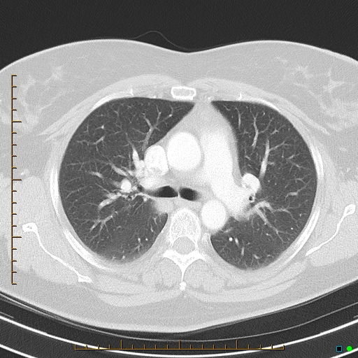 Bronchial diverticula (Radiopaedia 79512-92675 Axial lung window 19).jpg