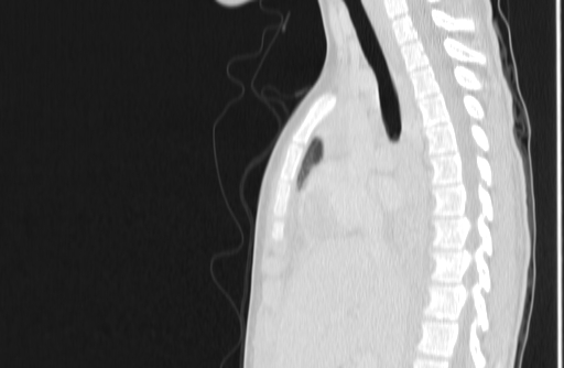 Bronchial mucoepidermoid carcinoma (Radiopaedia 57023-63895 Sagittal lung window 70).jpg