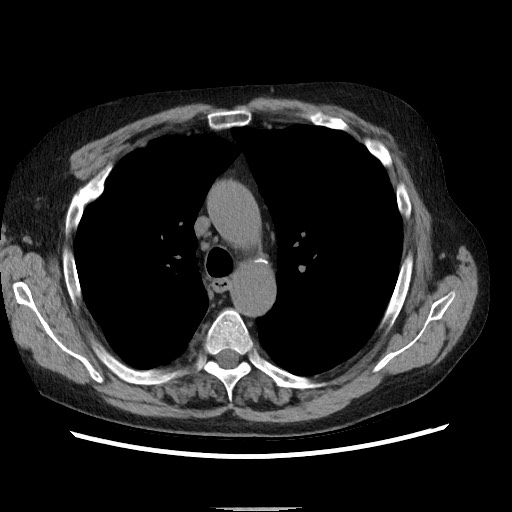 Bronchial stenosis - lung transplant (Radiopaedia 73133-83848 Axial non-contrast 23).jpg