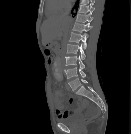 Bronchiectasis in Crohn disease (Radiopaedia 60311-67977 Sagittal bone window 110).jpg