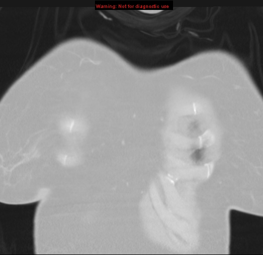 Bronchoalveolar carcinoma (BAC) (Radiopaedia 13436-13392 Coronal lung window 4).jpg